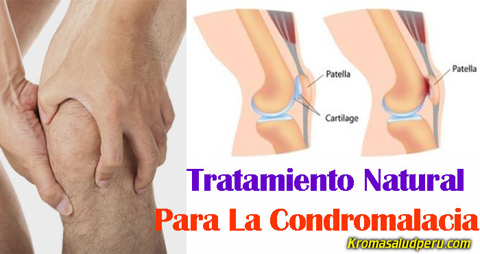 Tratamiento Natural De La Condromalacia Tratamiento Natural De La Condromalacia