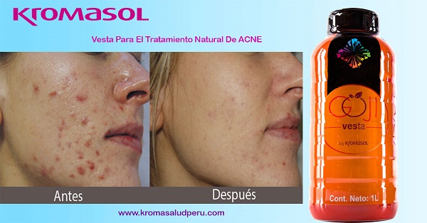 Beneficios del Vesta en Tratamientos Para el Acné Beneficios del Vesta en Tratamientos Para el Acné